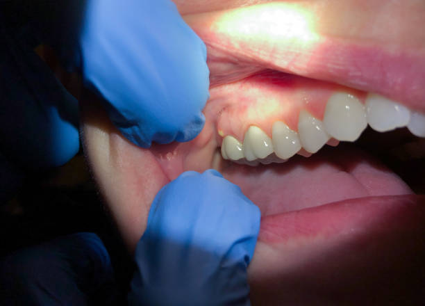 Best Emergency Treatment for Dental Infections or Abscesses in New Berlin, WI